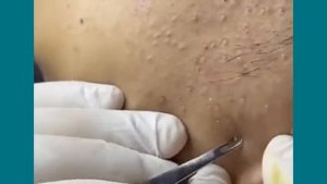 BEST BLACKHEADS EXTRACTION how to remove blackheads at home part 2