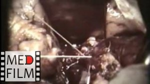 Резекция поджелудочной железы © Pancreatectomy