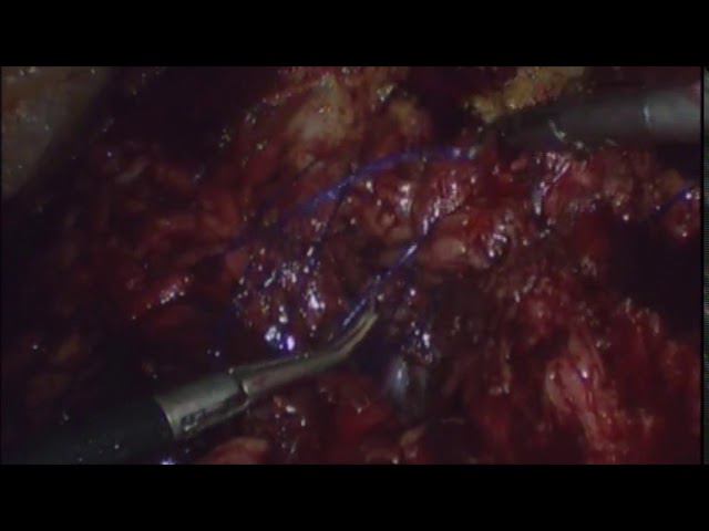 laparoscopic or endoscopic subcutaneus onlay ventral hernia repair смотреть онлайн