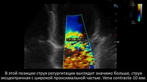 Кейс #3 Пролапс митрального клапана. Что с функцией клапана?