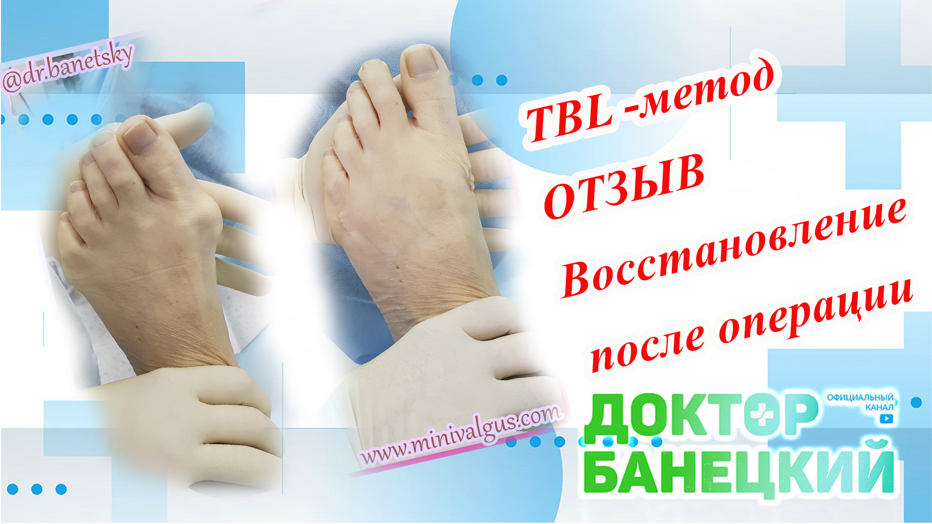 Честный отзыв пациентки об операции на стопах TBL-методом.