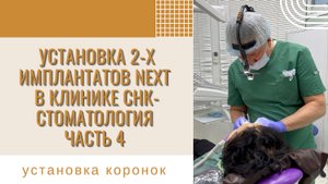 Установка 2-х имплантов в клинике СНК-Стоматология. Часть 4. Ортопедический этап - установка коронок