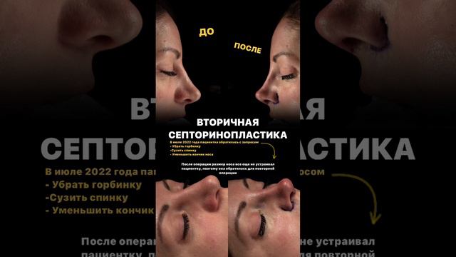 Вторичная септоринопластика