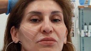 МЕЗОНИТИ: подготовка к процедуре (разметка), введение мезонитей.