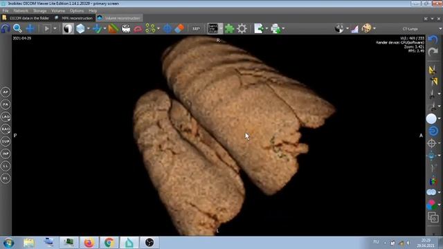 КТ ЛЕГКИХ . смотреть онлайн