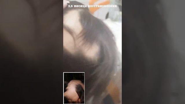 Облысение. Алопеция. Восстановление роста волос