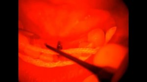 Шинирование с использованием набора "Армосплинт"