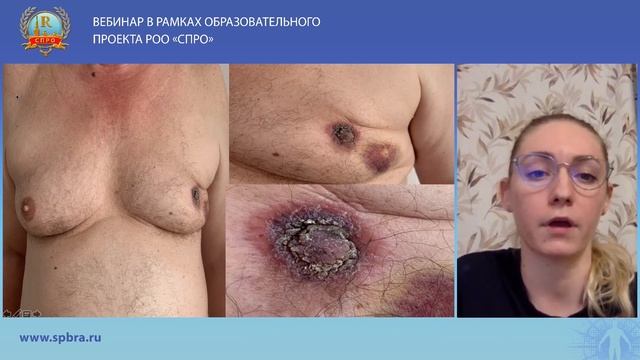 Особенности ультразвуковой картины истинной гинекомастии и рака молочной железы у мужчин смотреть онлайн