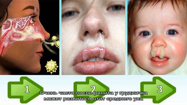 Может ли быть насморк при ангине? смотреть онлайн