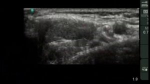 Введение в проводниковую анестезию под УЗИ контролем