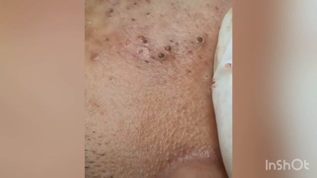 Big blackheads | Давим черные точки и прыщи