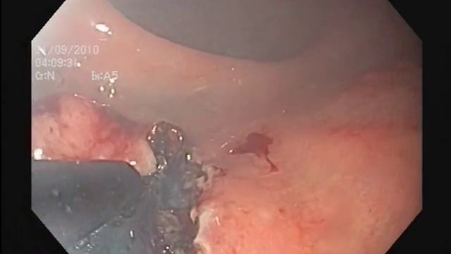 Early rectal cancer / рак прямой кишки