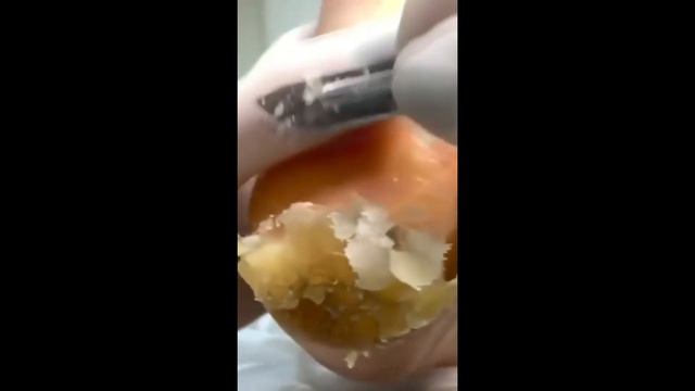 выдавливание прыщей | выдавливание чёрных точек