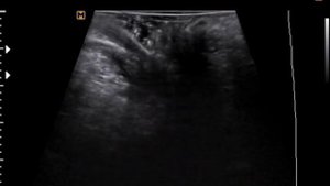 УЗИ прямой кишки (свищ прямой кишки)