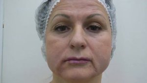 Убираем губоподбородочные складки