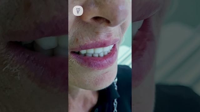 Циркониевая балка на верхней челюсти и коронки на нижней. Имплантация зубов. Первая стоматология.