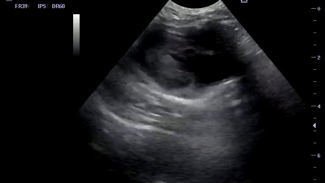 ГКМП без обструкции ВТЛЖ смотреть онлайн