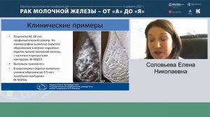 Лекция: «Возможности современных методов лучевой диагностики в диагностике рака молочной железы»