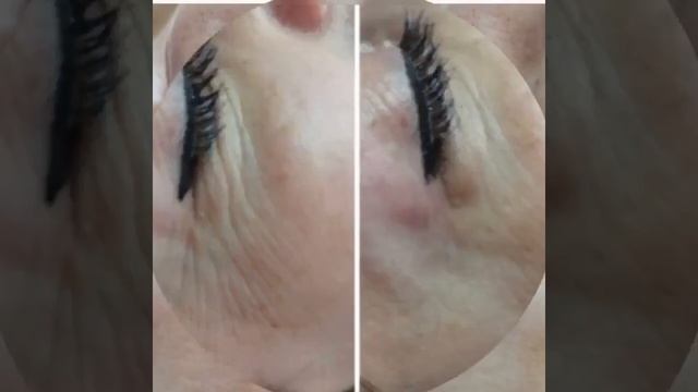 Пилинг с эффектом биоревитализации Evasion Derma Reverse Peel