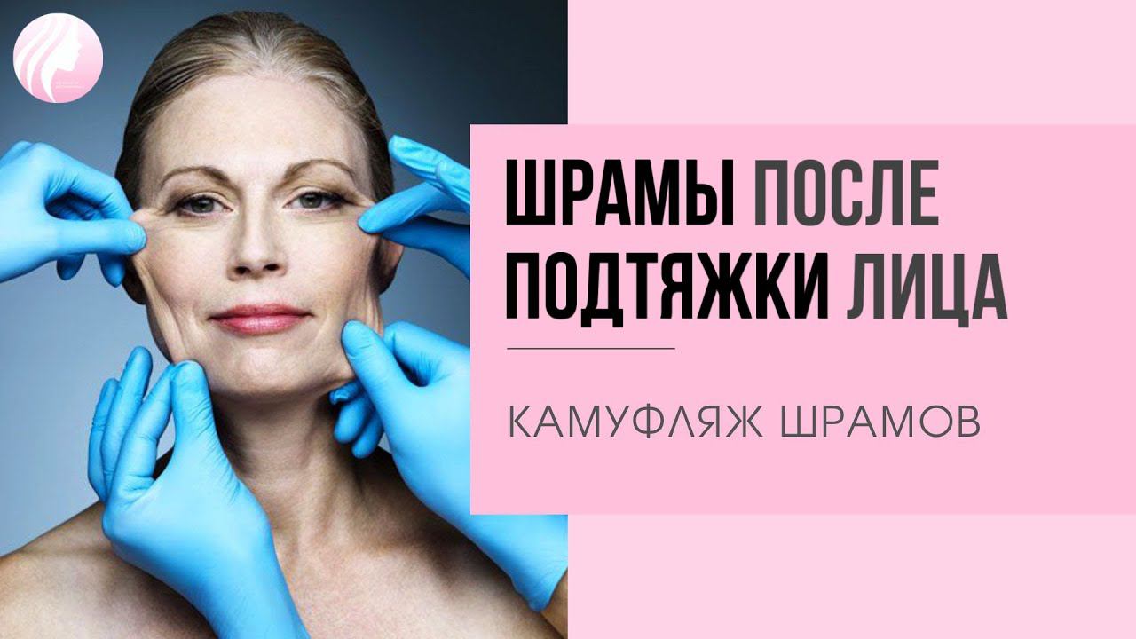 Остались ШРАМЫ после подтяжки лица SMAS LIFTING. Камуфляж шрамов процесс