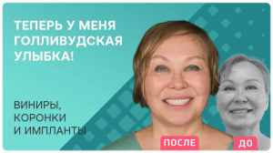 Тотальное преображение улыбки ? импланты Straumann и виниры на зубы