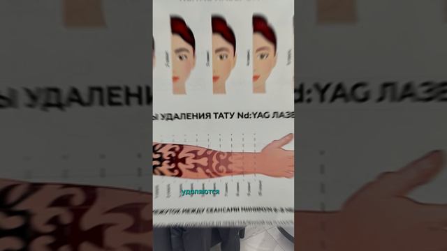 УДАЛЯЕМ ДО ЧИСТОЙ КОЖИ #shorts #татуировка #лазерноеудалениетату #ярославль #лазерноеудалениетатуажа