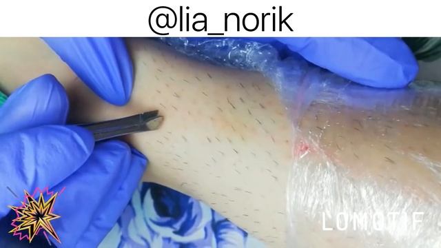 Электроэпиляция-избавление волом навсегда, процесс работы. смотреть онлайн