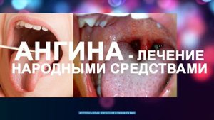 Ангина гнойная фото