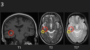 Introduction to MRI of the brain