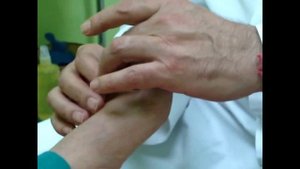 Молоткообразные и когтеобразные пальцы. ортезы силиконовые