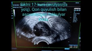 Фолликулометрия. Фолликуламетрия нима?Зоб касаллигининг хомиладорликка таъсири.