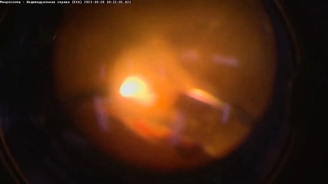 Кровоизлияние в стекловидное тело у ребёнка смотреть онлайн