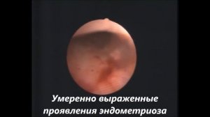 Гистероскопия у девственницы? Реально! (видео для врачей)