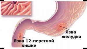Выделение крови из заднего прохода. Примесь крови