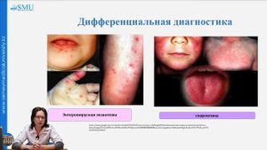 Ветряная оспа