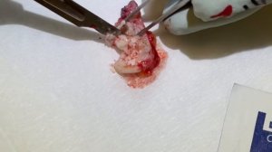 Blackheads with a side of cyst.Blackhead extractions and cyst excision with closure.Cyst dissection