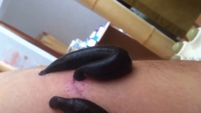 Пиявки, кровососущие пиявочки ;) Разжижали мне шрам от ранения... смотреть онлайн