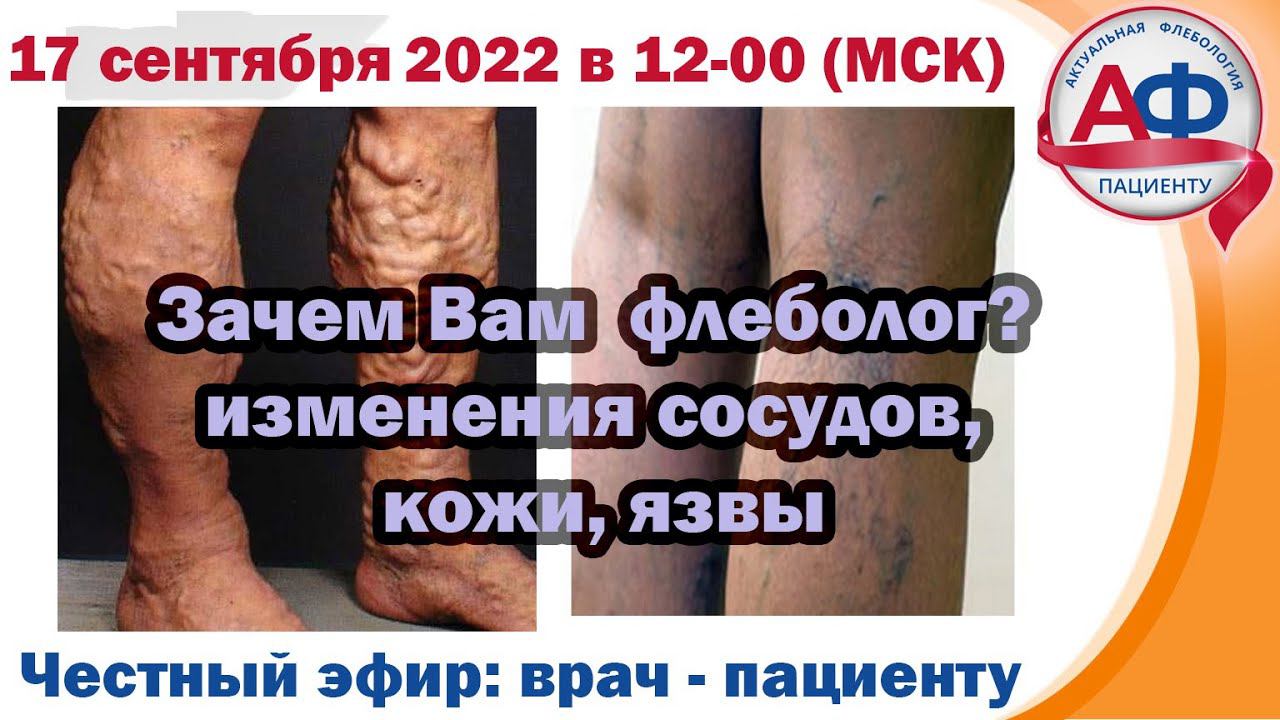 Вам нужен не флеболог! внешний вид сосудов, кожи, язв