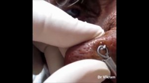 TOP 5 pimples Выдавливание прыщей