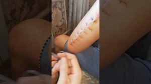 Как снять швы в домашних условиях.