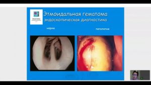 ЭТМОИДАЛЬНАЯ ГЕМАТОМА У ЛОШАДЕЙ, Часть-2 семинара MAXIMA VET для ветврачей, Вологда, 01-04-2021