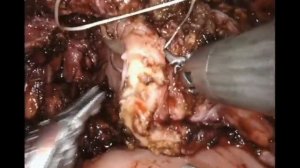 19.167 GYN - Robotic Assisted Laparoscopic Resection of Bladder and Ureteral Endometriosis