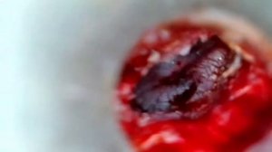 При стапедопластике все разрезы внутри уха.