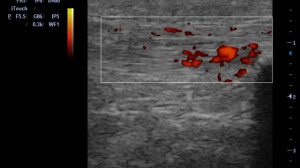 Лигаментит собственной связки надколенника