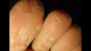 Почему облазит кожа на ступнях ног?