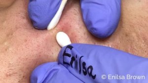 Blackheads, Whiteheads Extractions on "K" - Part 2