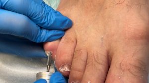 Тайна лечения грибка ногтей. Психика и Здоровье