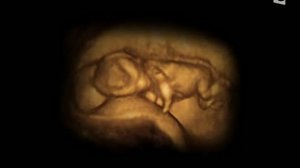 Echographie 4D (video) à 11 semaines de grossesse