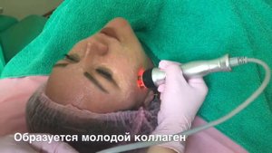 RF лифтинг