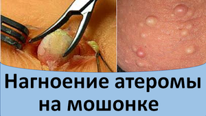 Нагноение атеромы на мошонке